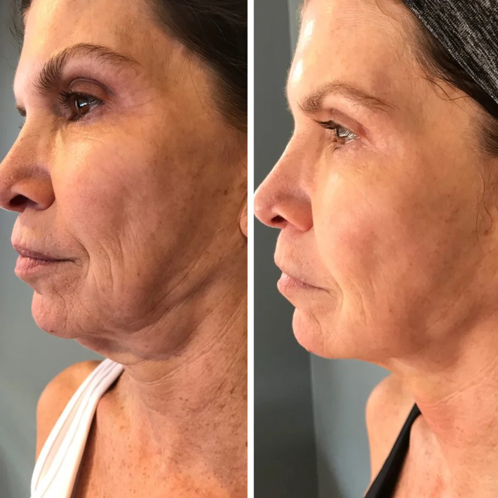 Cryo Facial before and after showing smoother-looking skin texture