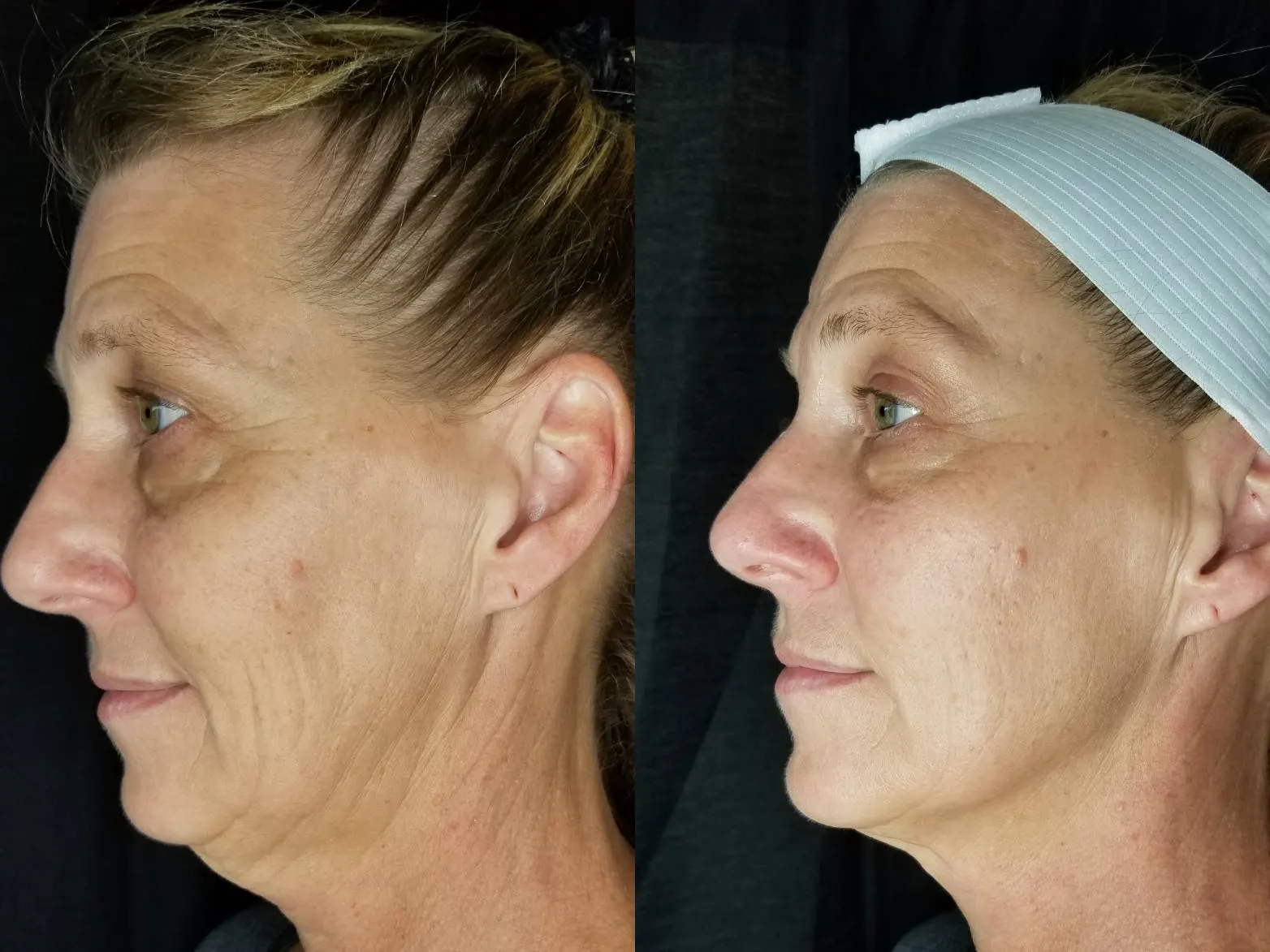 Cryo Facial before and after showing more defined-looking facial contours
