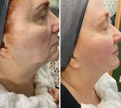 Cryo Facial before and after showing a refreshed facial profile