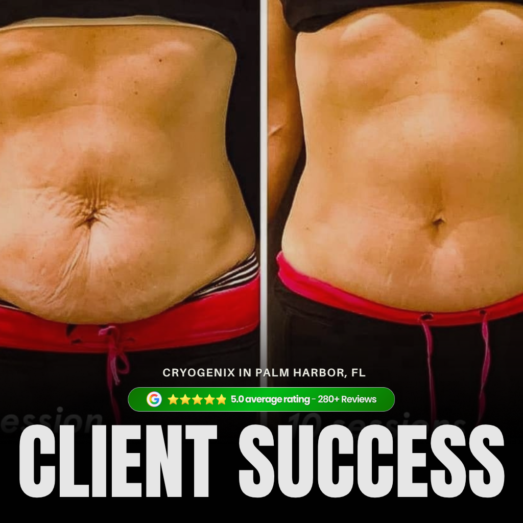Laser-Lipo before and after showing abdominal skin tightening and fat reduction results